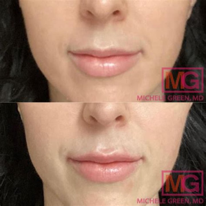 Megan Rapinoe Plastic Surgery: Botox And Lip Filler Photos Before And After